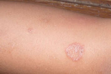 body ringworm or tinea corporis