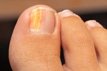 fungal nail infection or onychomycosis