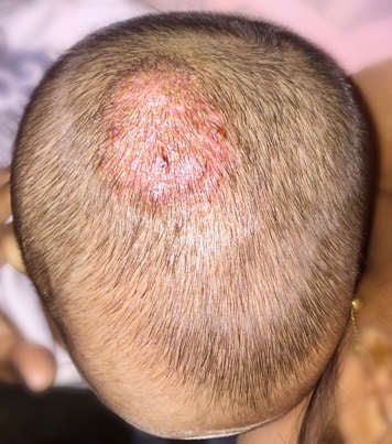 scalp ringworm or tinea capitis