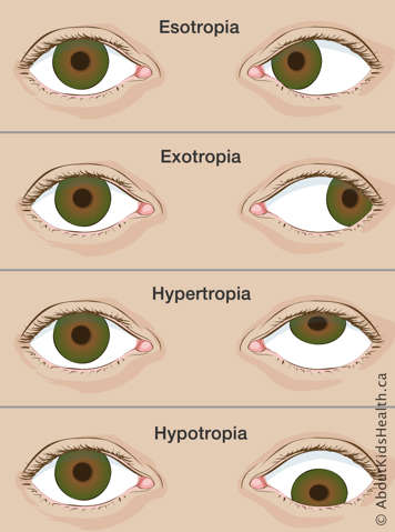 Pairs of eyes with esotropia, exotropia, hypertropia and hypotropia