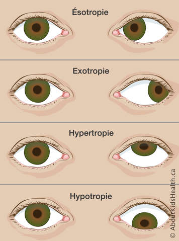 Des pairs de yeux avec l’ésotropie, l’exotropie, l’hypertropie et l’hypotropie