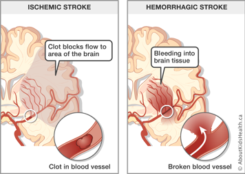 A clot in the blood vessel blocking flow to an area of the brain and a broken blood vessel bleeding into brain tissue