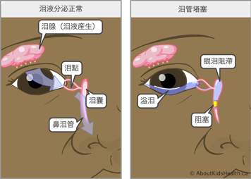 淚液分泌正常的眼睛，以及淚管阻塞的眼睛，後者會導致眼淚在淚囊中積聚，使患者多淚