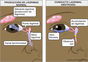 Ojo con producción normal de lágrimas y ojo con conducto obstruido, causando acumulación en el saco lagrimal y ojos llorosos