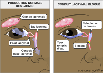 Œil avec production normale des larmes et œil avec conduit lachrymal bloqué, causant le refoulement de larmes
