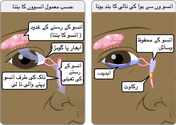 ارمل آنسو پیدا کرنے والی آنکھ اور آنسو والی بند نالی والی آنکھ جو  پانی بھری آنکھوں کا سبب ہے