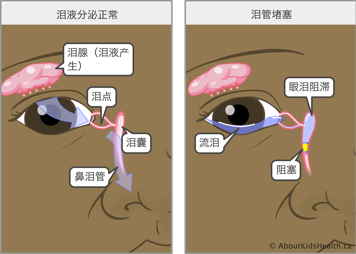 泪液分泌正常的眼睛，以及泪管阻塞的眼睛，后者会导致眼泪在泪囊中积聚，使患者多泪
