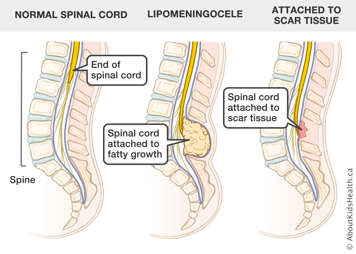 A normal spinal cord, a spinal cord attached to fatty growth and a spinal cord attached to scar tissue
