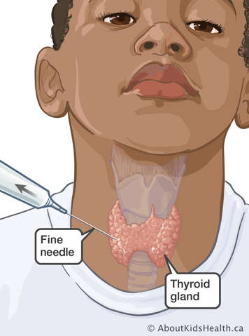 Fine needle inserted into thyroid gland