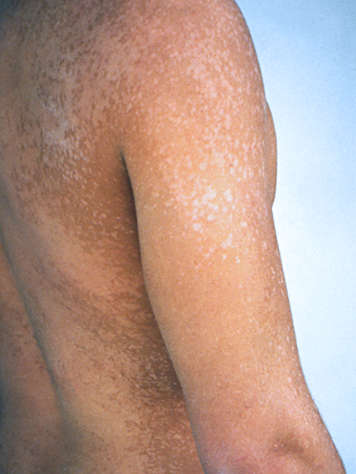 Adolescent avec une infection au champignon pityriasis versicolor sur le dos, les épaules et les bras