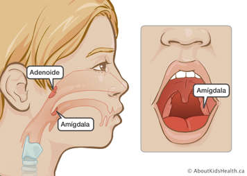 Localización de las adenoides y las amígdalas