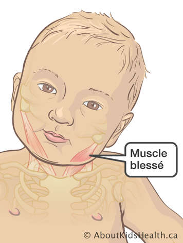 Muscle blessé dans le cou et la joue d’un bébé