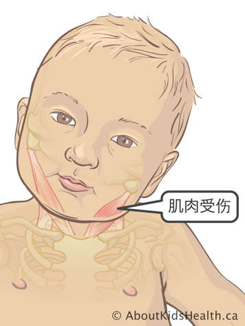 宝宝颈部和面颊的肌肉受损