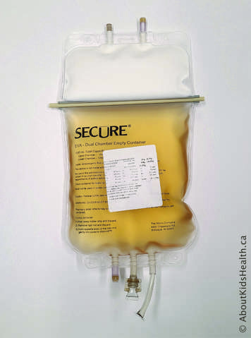 Parenteral nutrition bag with white lipid in upper portion and clear amber fluid in lower chamber