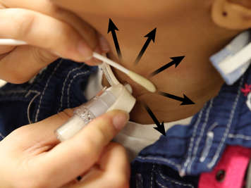 Wiping outward from the stoma using a saline-soaked swab.