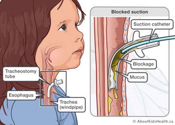 Illustration of child with mucous blocking their tracheostomy tube