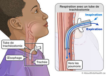 Illustration de la respiration avec un tube de trachéostomie