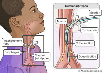 illustration showing tracheostomy tube in the trachea and how far to suction for tube suctioning