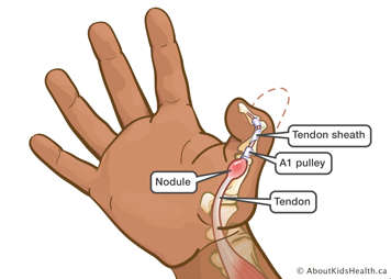 Hand showing the bones, tendon, tendon sheath, A1 pulley and nodule of a trigger thumb