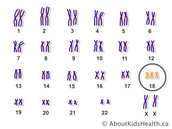 Les paires de chromosomes d’une femelle avec une copie supplémentaire du chromosome 18