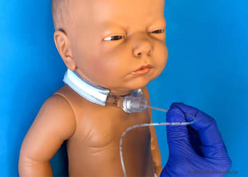 Suctioning the child after CoughAssist treatment