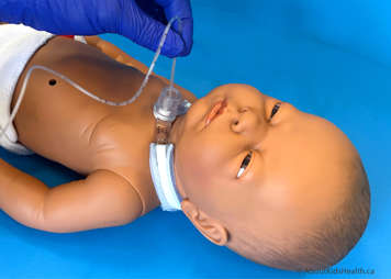 Suctioning a child's tracheostomy tube