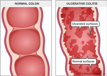 Close-up of normal colon and close-up of colon with ulcerative colitis