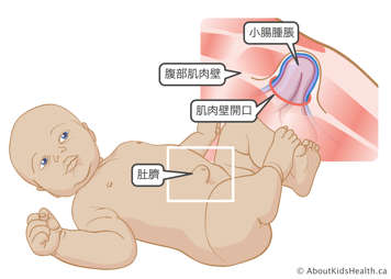 突破嬰兒腹壁並鼓出的腸子