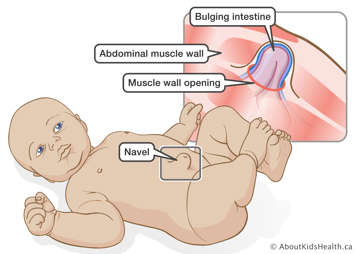 Bulging navel on a baby and an illustration of a bulging intestine through an opening in the abdominal muscle wall