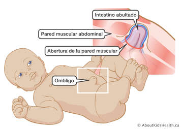 Ilustración del intestino sobresaliendo a través de una apertura en la pared muscular del abdomen de un bebé