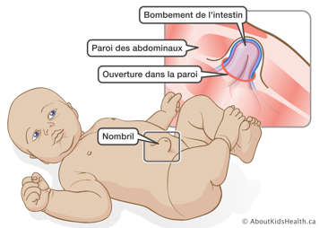 Bébé avec nombril bombé et une illustration du bombement de l’intestin à travers une ouverture dans la paroi des abdominaux