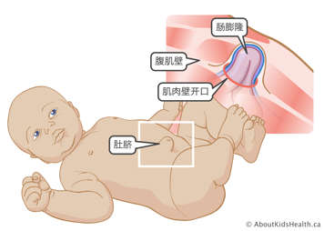 突破婴儿腹壁并鼓出的肠子