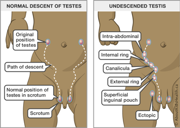 Path of normal descent of testes and the path and potential sites of undescended testes between the abdomen and scrotum
