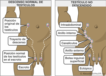 Trayecto normal de descenso de testículos y trayecto y zonas potenciales en testículos no descendidos entre abdomen y escroto
