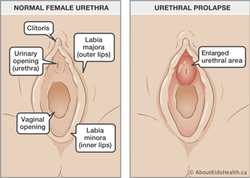Identification of clitoris, vaginal opening, labia minora, labia majora with normal urethra and with enlarged urethral area