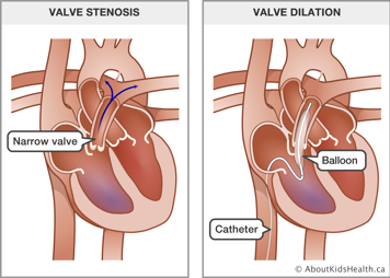 Illustration of valve stenosis and of valve dilation