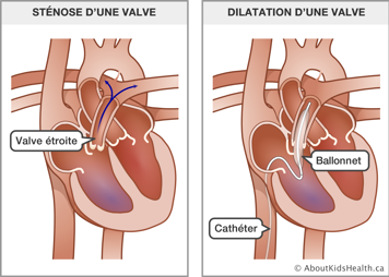Illustration de la sténose d’une valve et de la dilation d’une valve