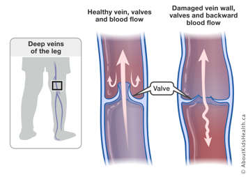 Normal blood flow in healthy vein and valves in the leg and backward blood flow in damaged vein wall and valves