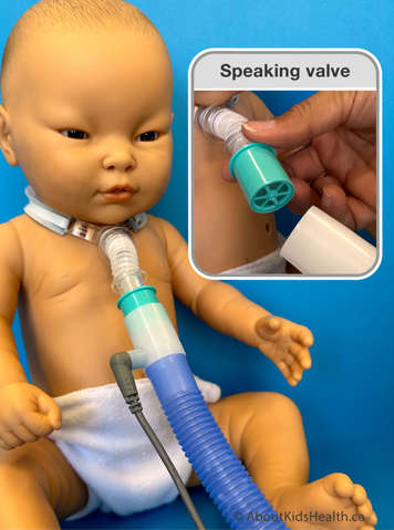 Child with a speaking valve that is in use with a ventilator