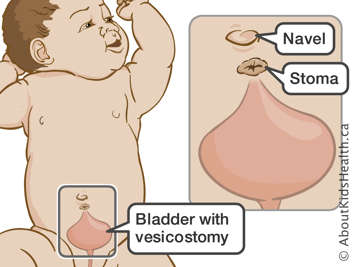 Bladder with vesicostomy in a baby and location of stoma and navel