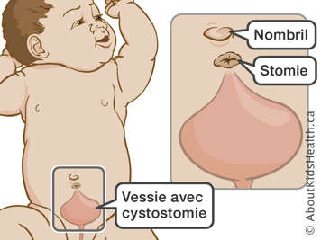 La vessie avec cystostomie dans un bébé et l’emplacement de la stomie et du nombril
