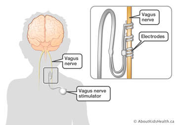 Vagus nerve stimulator attached to vagus nerve with electrodes