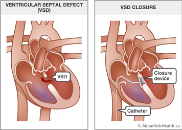 Heart with ventricular septal defect and heart with catheter and closure device inserted into VSD