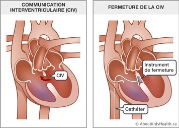 Un cœur avec communication interventriculaire et un cœur avec un cathéter et un instrument de fermeture insérés dans la CIV