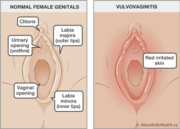 Normal female genitals and female genitals with red irritated skin