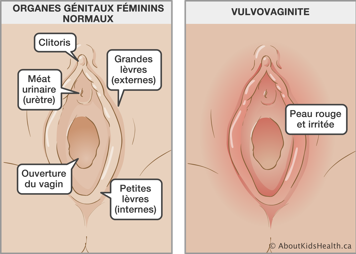 Organes génitaux féminins normaux et organes génitaux féminin avec la peau rouge et irritée